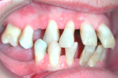 Clínica De Ortodoncia Doctores Diaz De Villafranca dientes torcidos